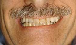 Dental Implant Supported Makeover with Crowns